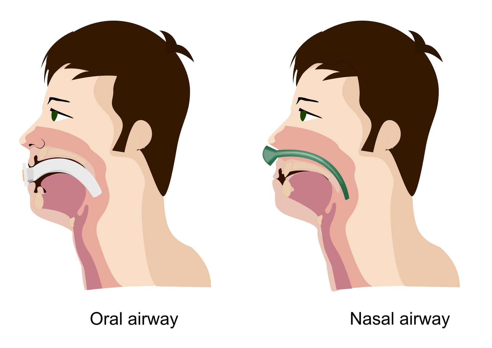 Endure Complete Airway Emergency KIT 4, 9 Guedel OPA, 3 NPA