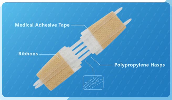 3 Zipstitches Plus More Supplies – Quick and Easy Skin Closure Devices