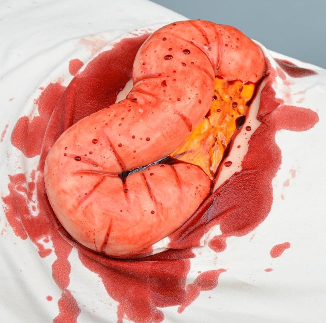 Adhesive Eviscerated Intestine Simulator, Open Abdominal Wound Packing Trainer